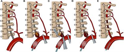 Safety and Blood-Flow Outcomes for Hybrid Recanalization in Symptomatic Refractory Long-Segmental Vertebral Artery Occlusion—Results of a Pilot Study